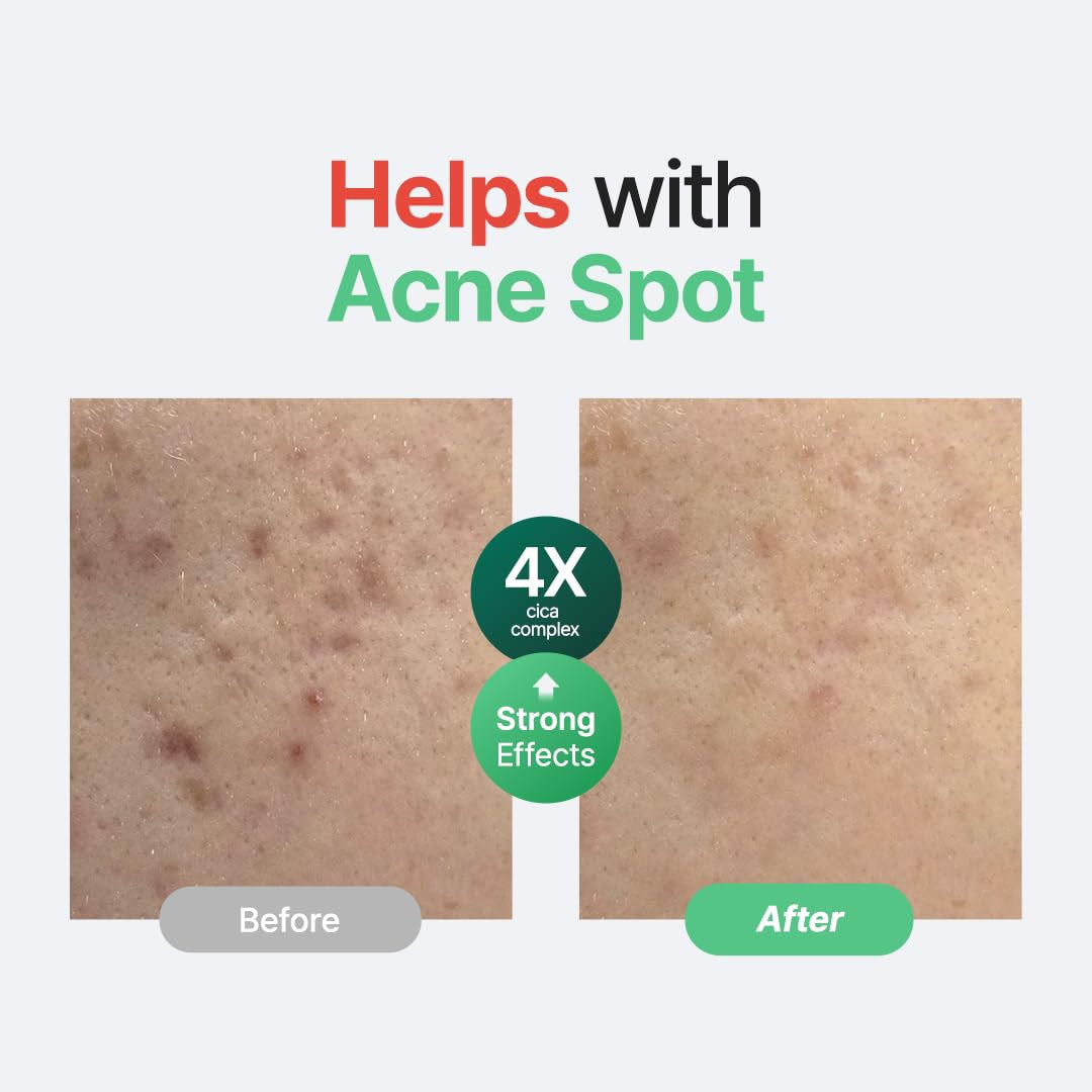 Centella Unscented Serum, 34,860 Ppm Centella, Facial Serum for Sensitive Skin & Acne-Prone Skin, Soothing Serum, Vegan & Cruelty-Free, Korean Skincare, 2 Fl.Oz / 60Ml